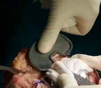فیلم قرار دادن پروتز مفصل زانو در زانوی بیمار 