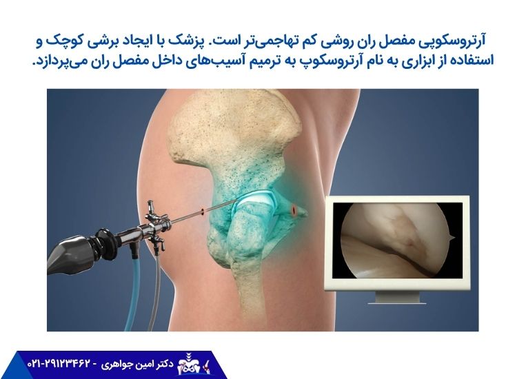 آرتروسکوپی مفصل ران