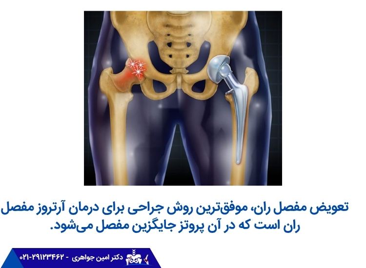 عمل جراحی تعویض مفصل ران