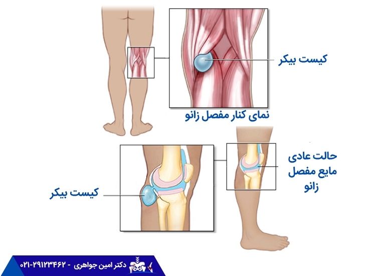 کیست بیکر چگونه به وجود می‌آید؟