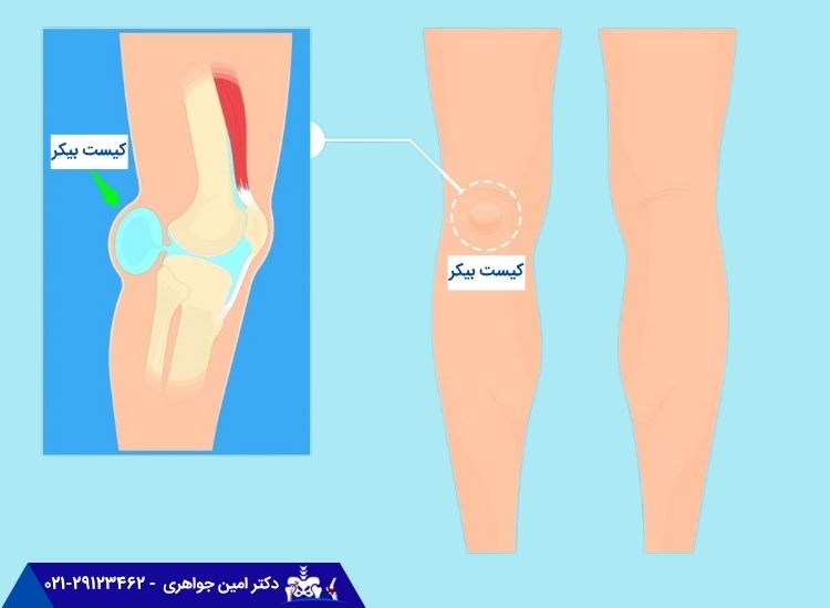 کیست بیکر چیست؟