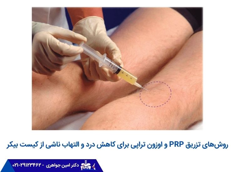 تزریق دارو به مفصل زانو برای درمان کیست بیکر