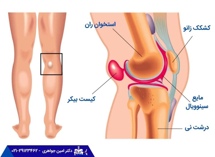 تشکیل کیست بیکر پشت زانو 