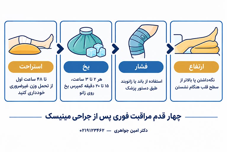 روش RICE برای مراقبت بعد از جراحی مینیسک زانو