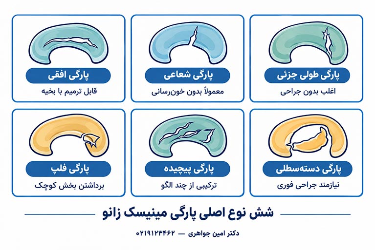 انواع پارگی مینیسک