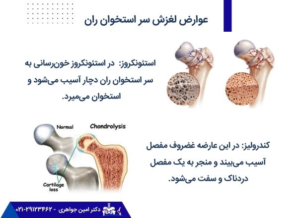 عوارض لغزش اپی فیز سر استخوان ران