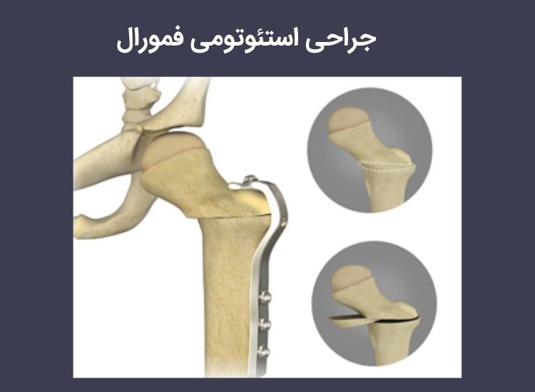 استئوتومی فمورال