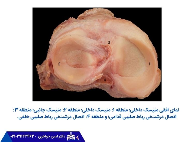 تصویر واقعی منیسک داخلی زانو