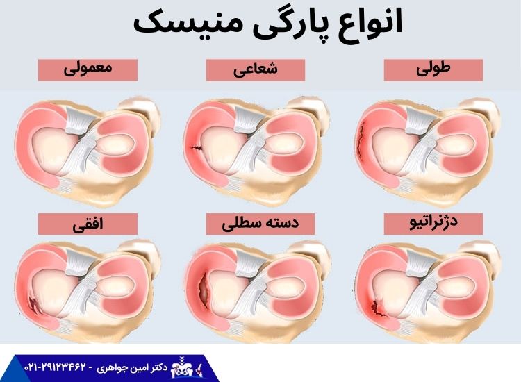 انواع چارگی منیسک