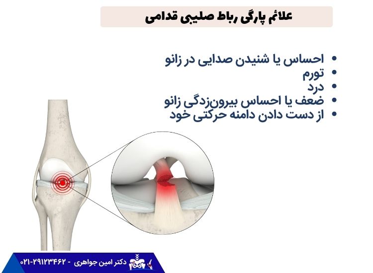 علائم پارگی رباط صلیبی زانو