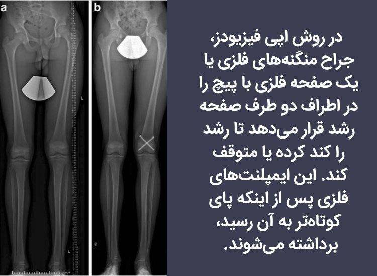 درمان اپی فیزیودز