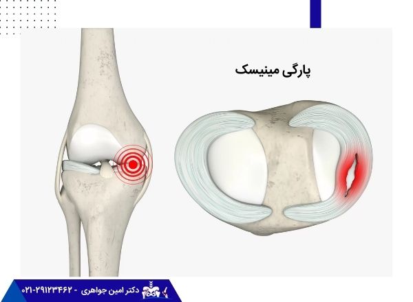 تصویر منیسک پاره از نمای بالا