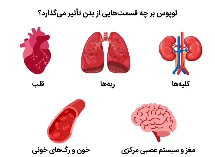 اندام هایی که درگیر لوپوس می شوند