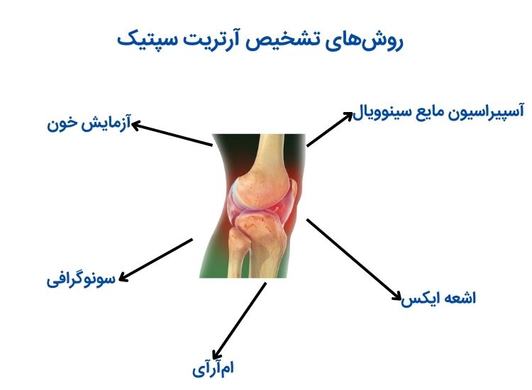 تشخیص آرتریت عفونی