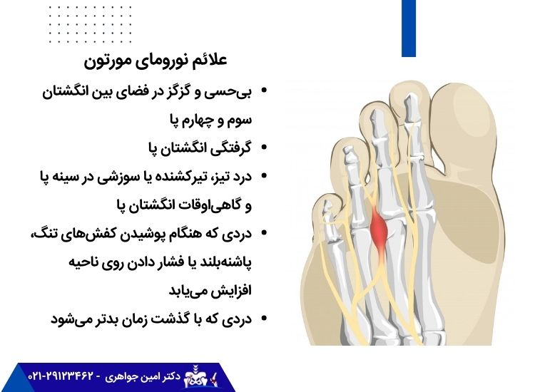 نورومای مورتون