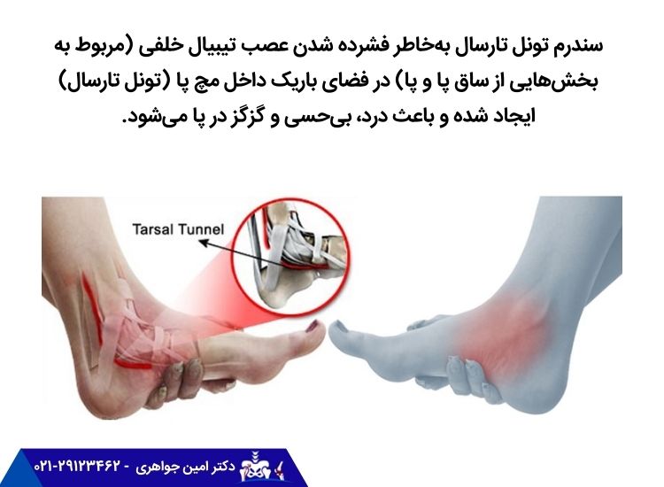 سندرم تونل تارسال