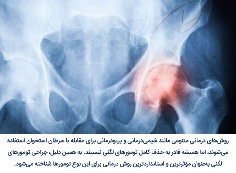 علت تومور لگن