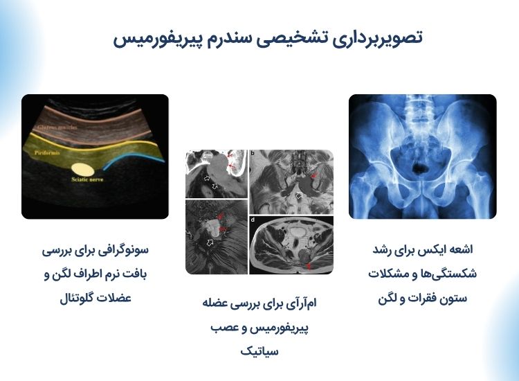 تشخیص سندرم پریمفریس