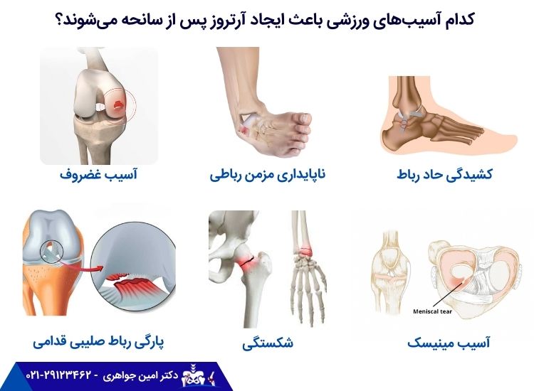 آسیب هایی که باعث آرترز پس از سانجه می شوند