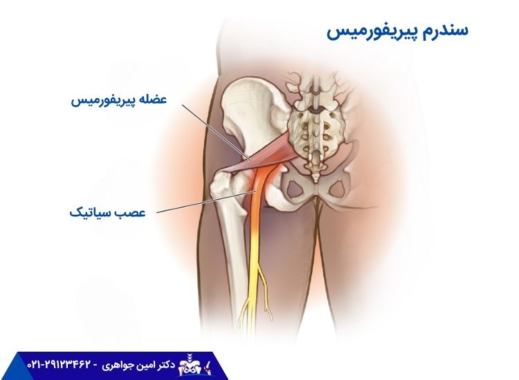 سندرم پریفرمیس