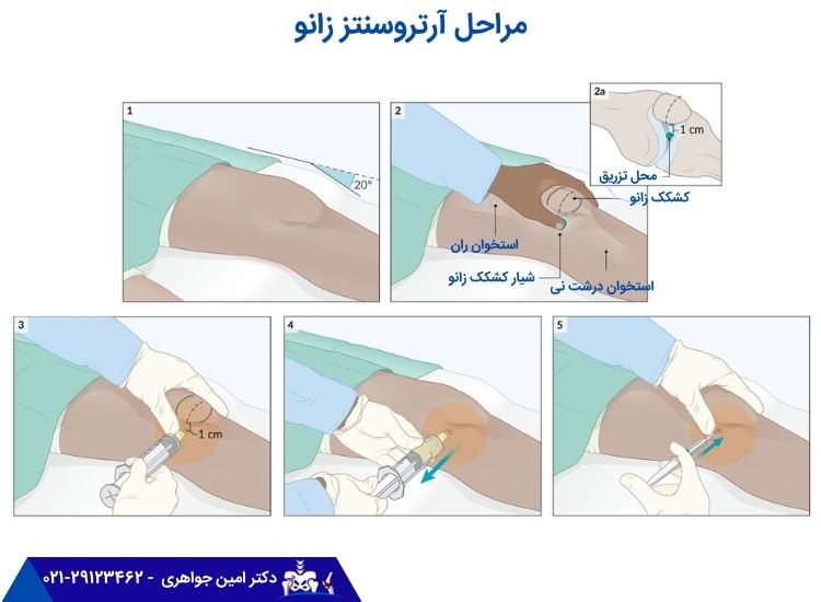 مراحل آرتروسنتز زانو