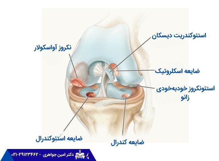 استئوکندرال زانو چیست