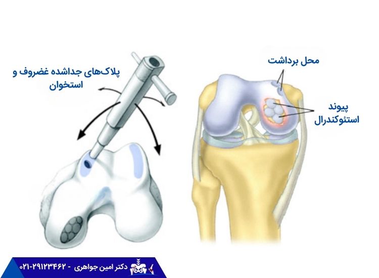 پیوند استئوکندرال