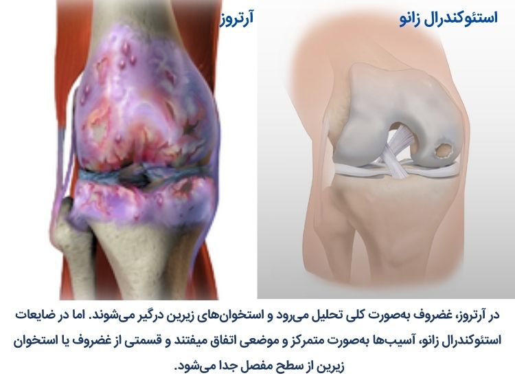 تفاوت استئوکندرال زانو با آرتروز