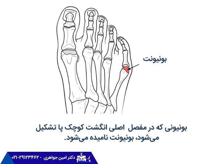 بونیونت