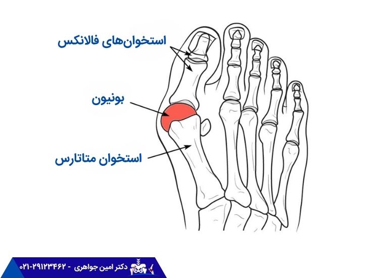 انواع بونیون