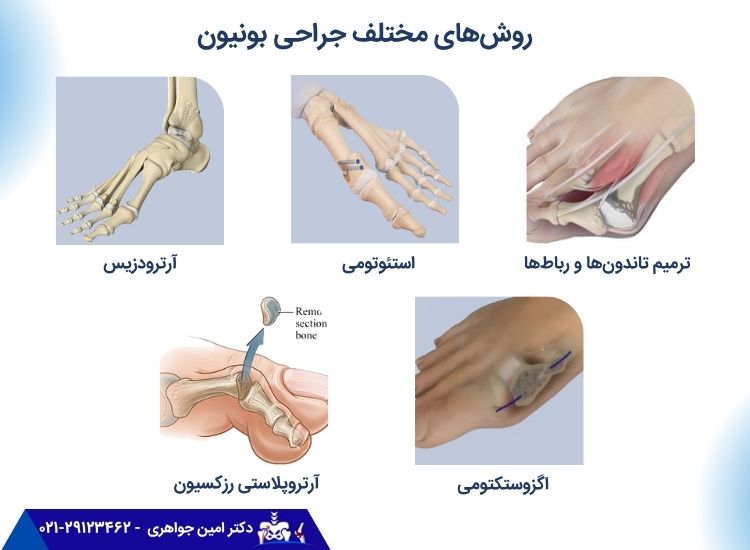 جراحی بونیون