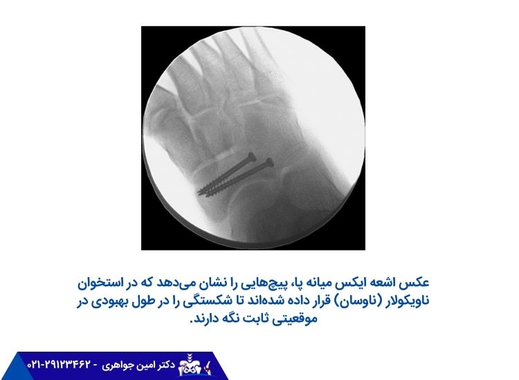 استفاده از پیچ های تثبیت کننده