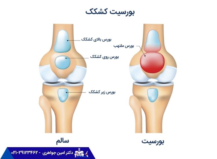 بورسیت زانو