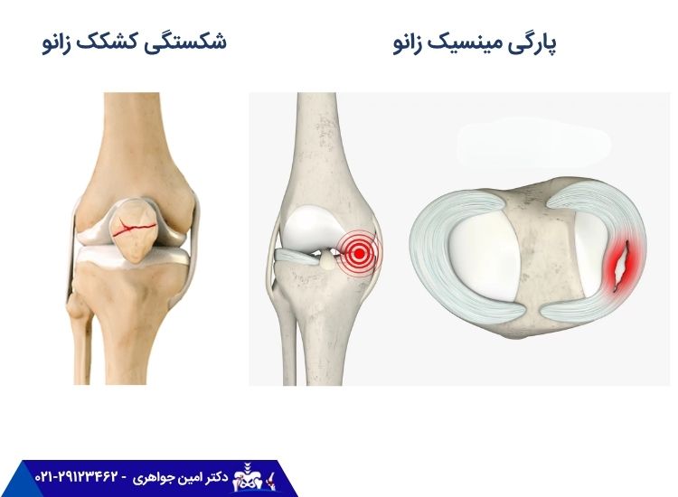 پارگی مینیسک