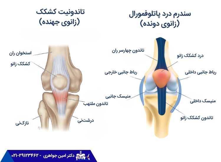 سندرم درد پاتلوفمورال
