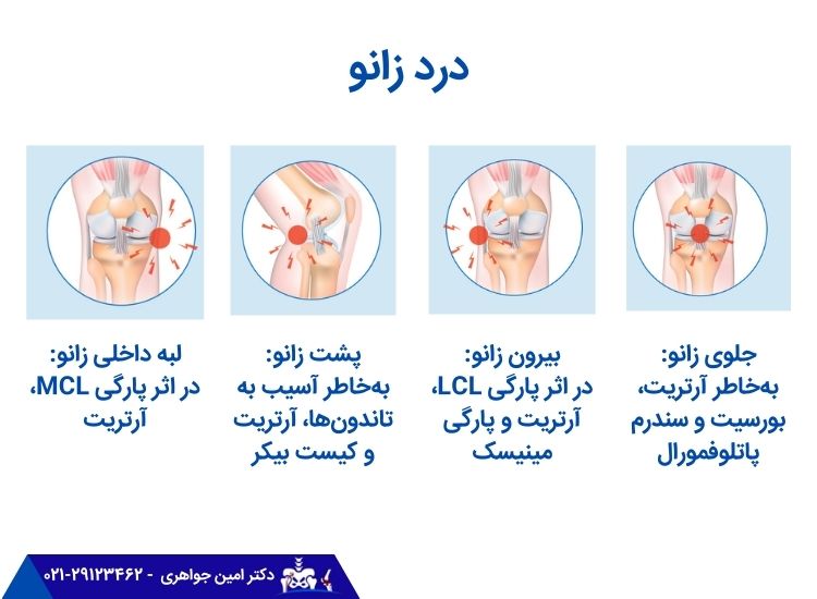 درد زانو