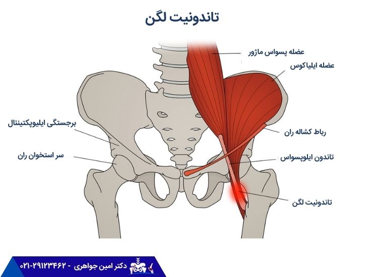تاندونیت لگن
