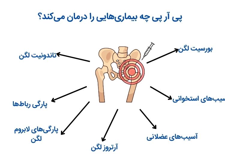 بیماریهایی که با prp درمان می شوند