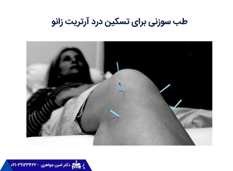 طب سوزنی برای درمان آرتریت