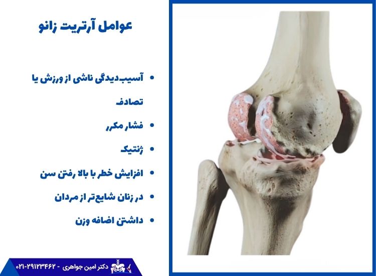 علت ابتلا به آرتریت