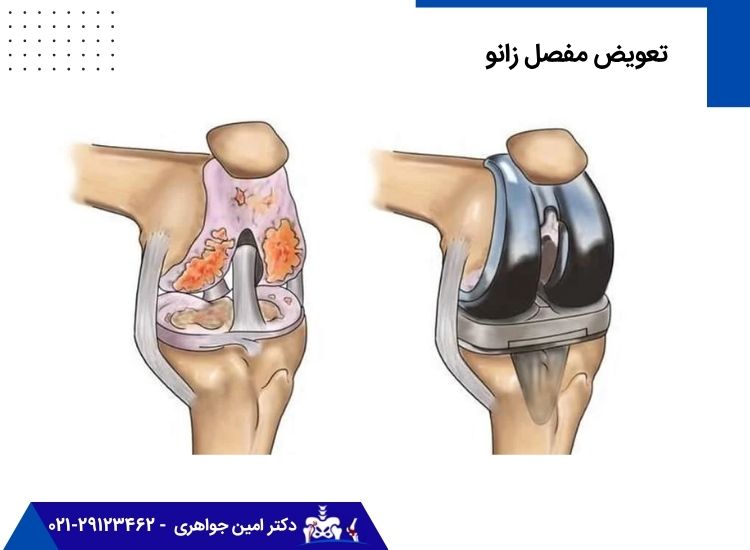 تعویض مفصل زانو