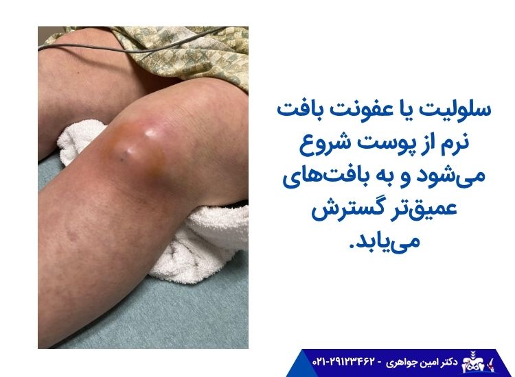 سلولیت- عفونت بافت نرم