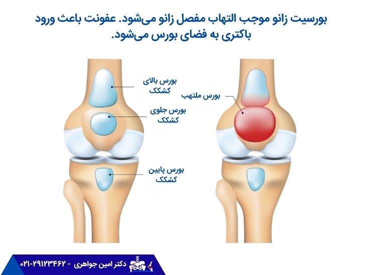 بورسیت زانو