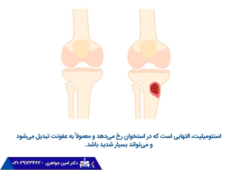 استئومیلیت