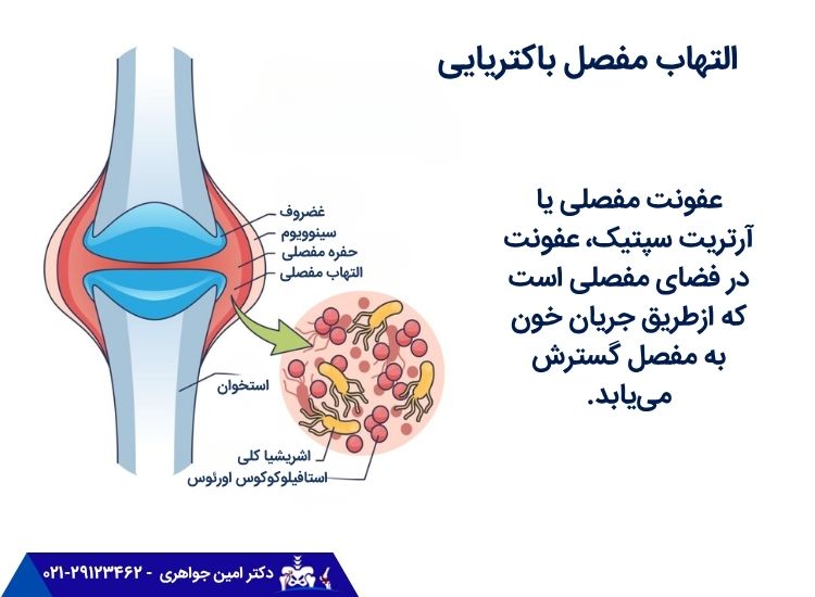 التهاب سپتیک
