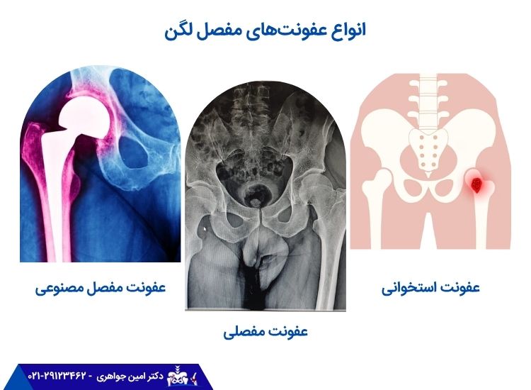 انواع عفونت لگن