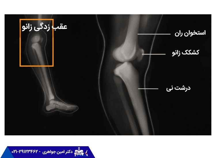 رادیوگرافی عقب زده