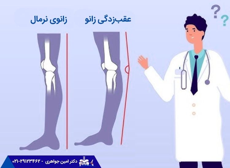 شکل عقب زدگی زانو