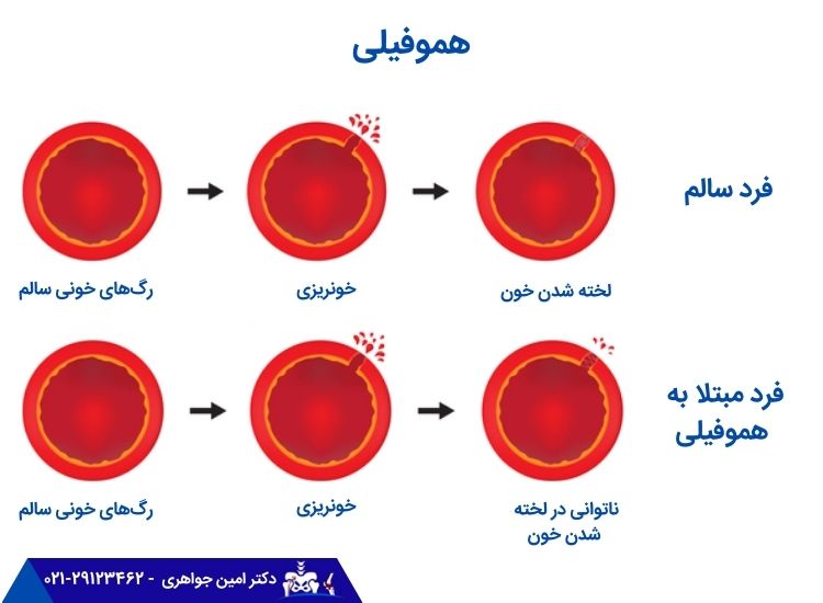 ناتوانی در لخته شدن خون بیماران هموفیلی