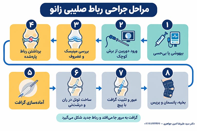 مراحل جراحی رباط صلیبی زانو از بیهوشی تا تثبیت گرافت